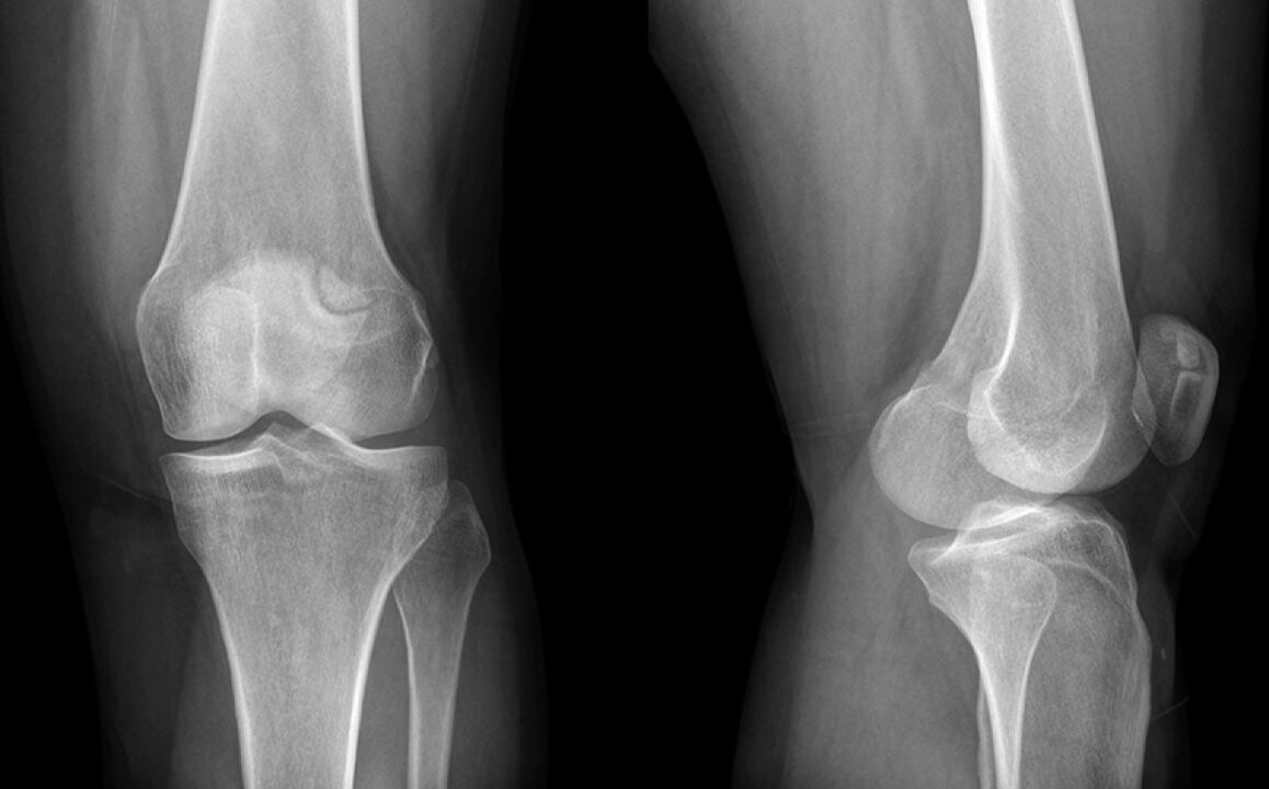 Knieosteoarthritis an der X -Linie vor Verwendung von Hondroine