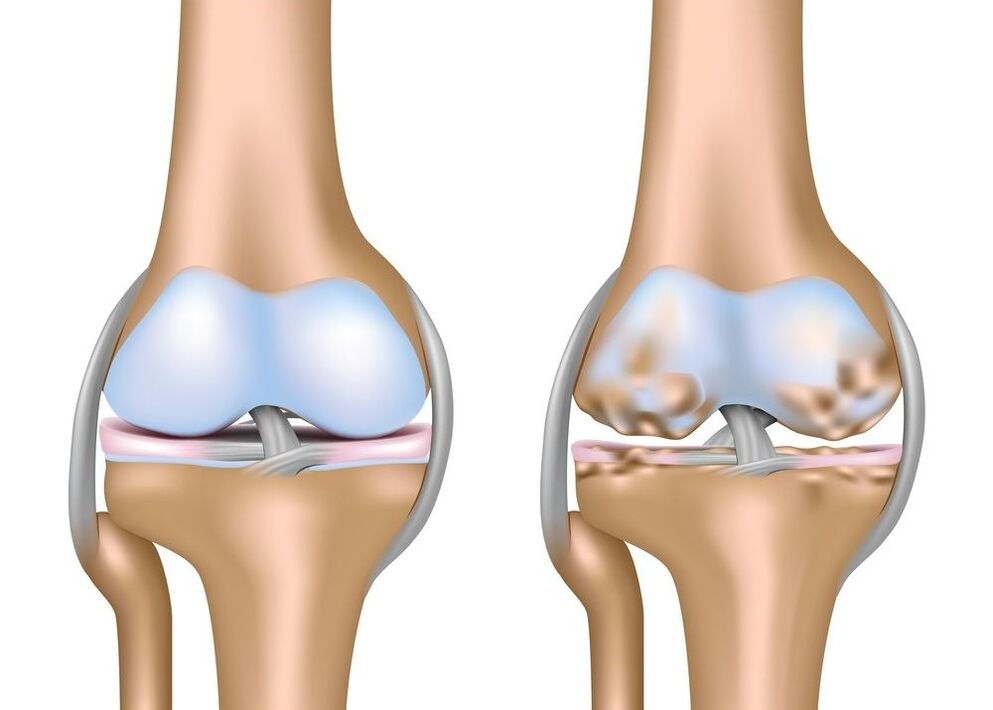 Kniegelenks -Osteoarthritis