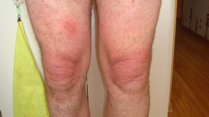 Arthrose der Kniegelenke.